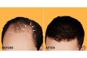 before after hair transplant