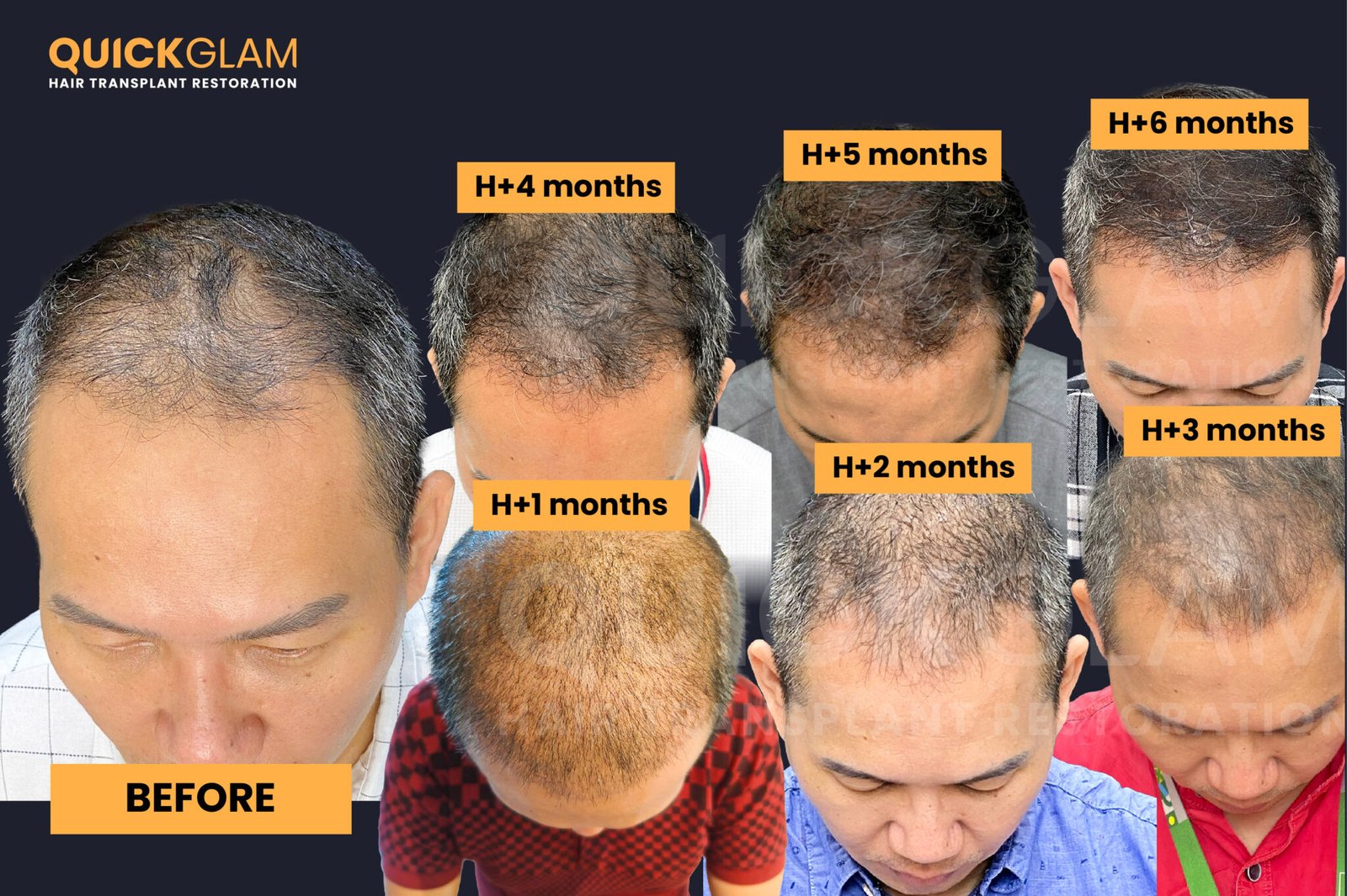 Proses Hair Transplant